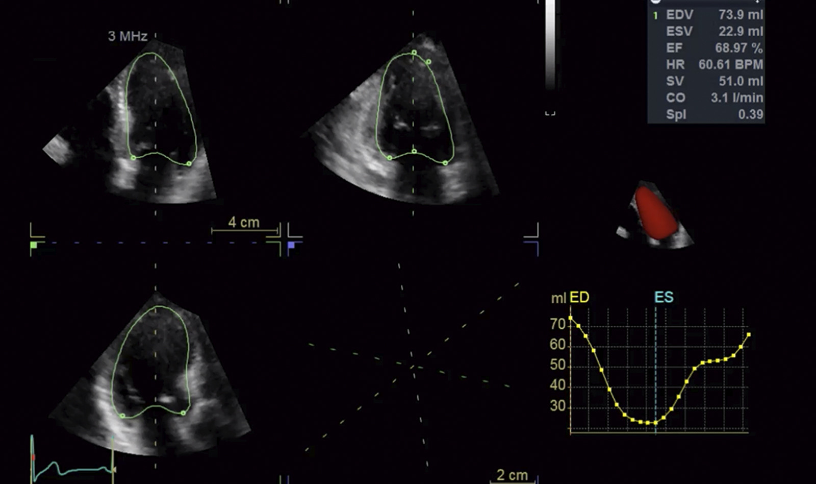 Image of lung ultrasound contrast enhanced ultrasound CEUS    Online PoCUS Training