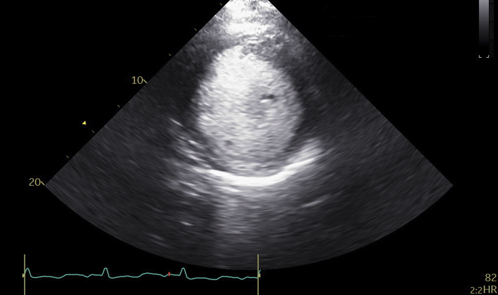 Image of measurements of cardiac size and function echocardiography critical care echocardiography    Online PoCUS Training