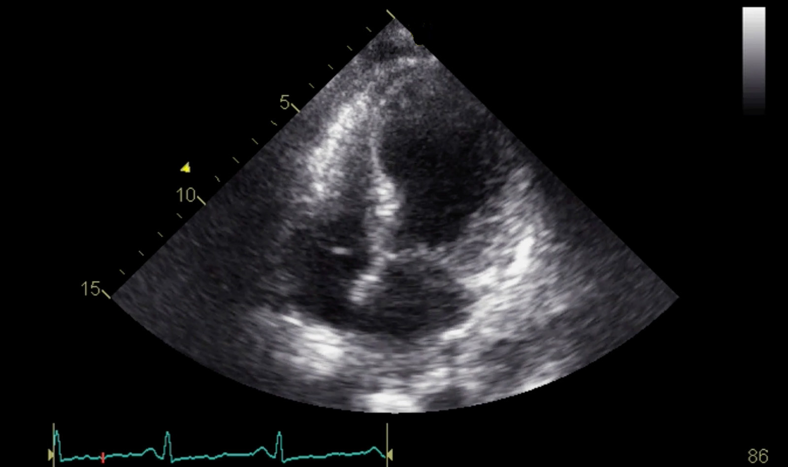 Image of pneumonia cardiac ultrasound    Online PoCUS Training