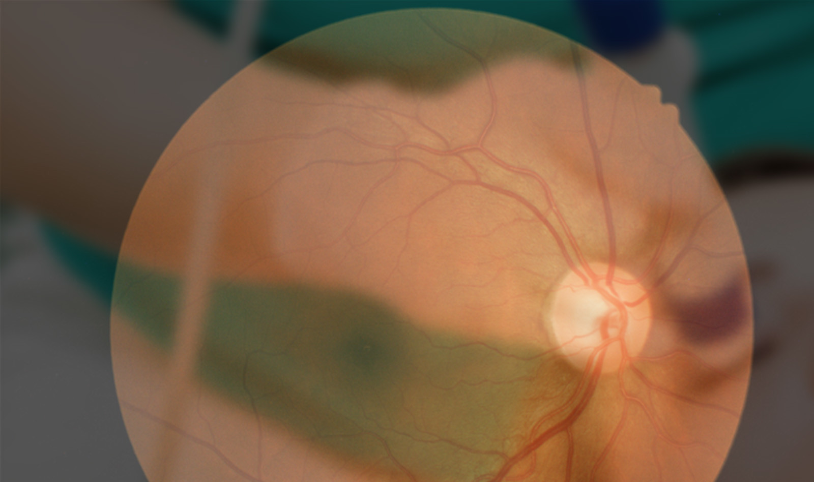 Image of ultrasound of the eye optic nerve ultrasound    Online PoCUS Training