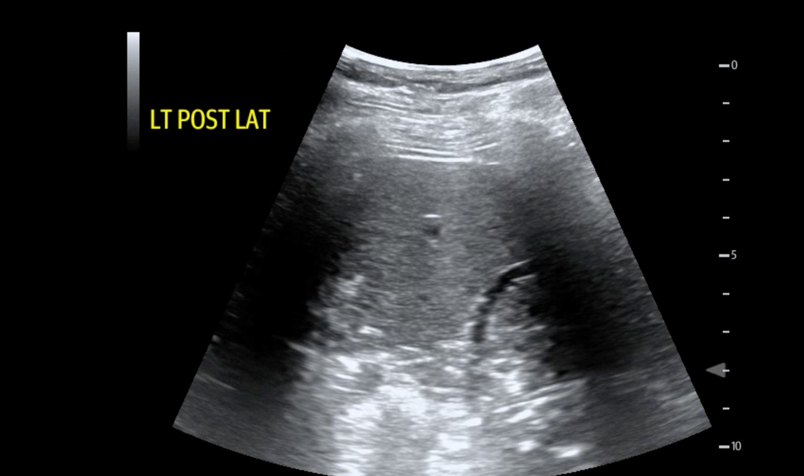 Image of pneumonia COVID 19 cardiac ultrasound    Online PoCUS Training