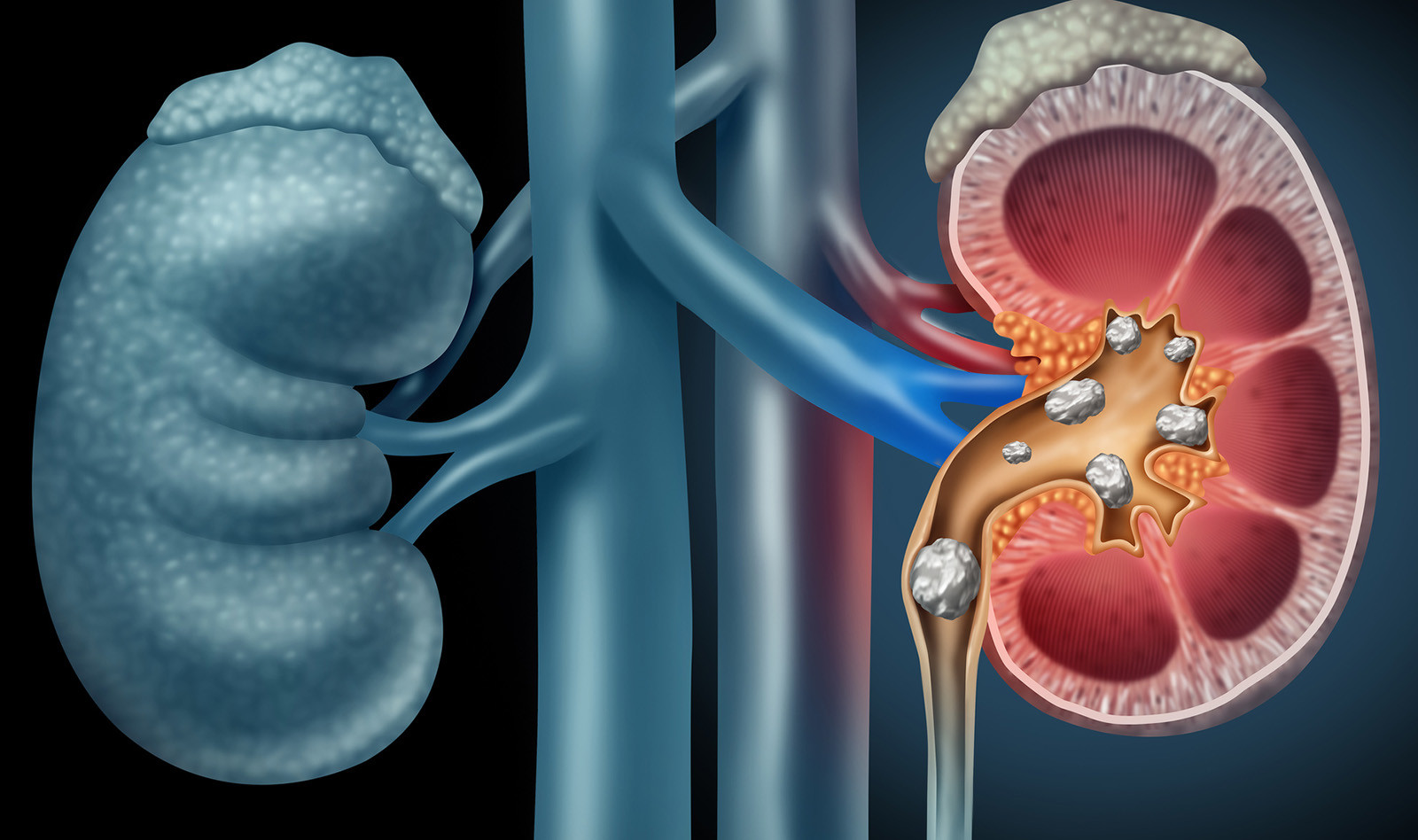 Image of renal ultrasound renal colic point of care ultrasound PoCUS PoCUS PoCUS PoCUS PoCUS PoCUS PoCUS PoCUS PoCUS kidney ultrasound    Online PoCUS Training