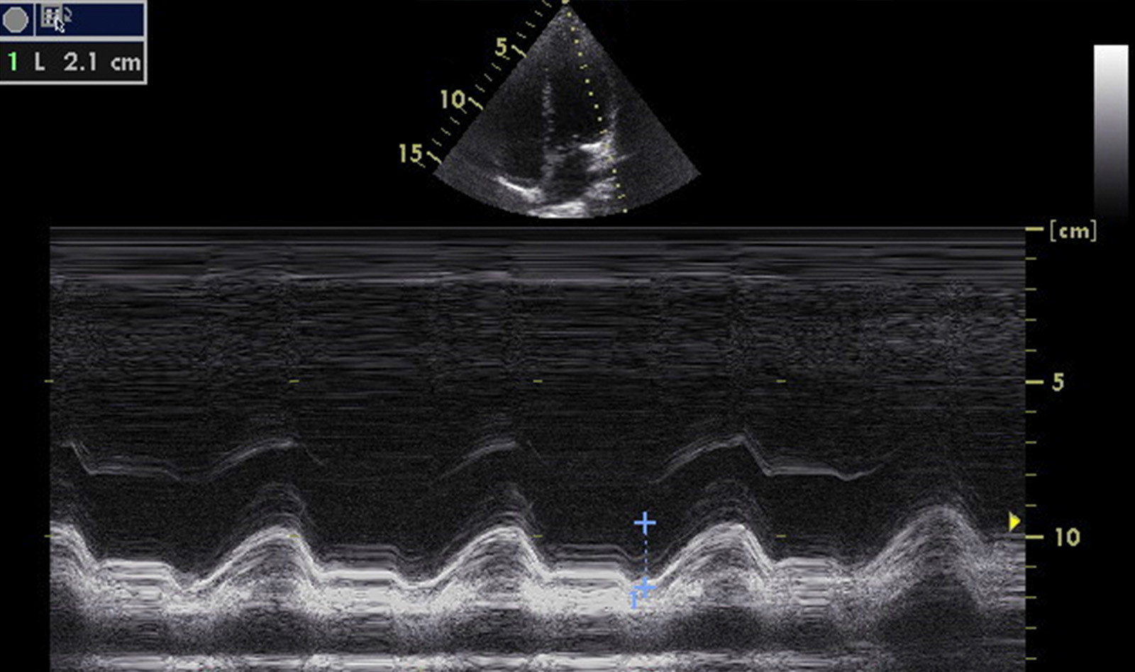 Image of renal ultrasound point of care ultrasound PoCUS kidney ultrasound    Online PoCUS Training