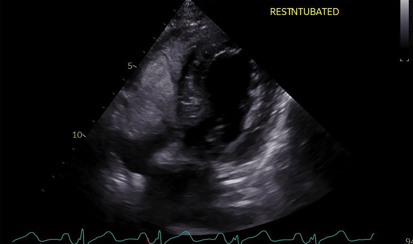 Image of point of care ultrasound cardiac ultrasound    Online PoCUS Training
