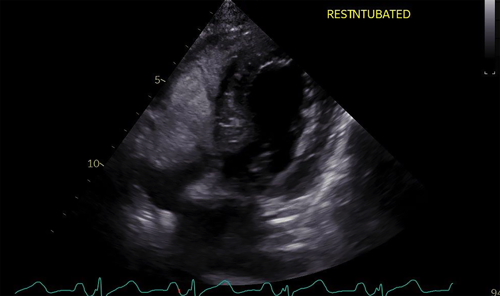 Image of CTA critical care ultrasound CEUS cardiac ultrasonography angiography    Online PoCUS Training