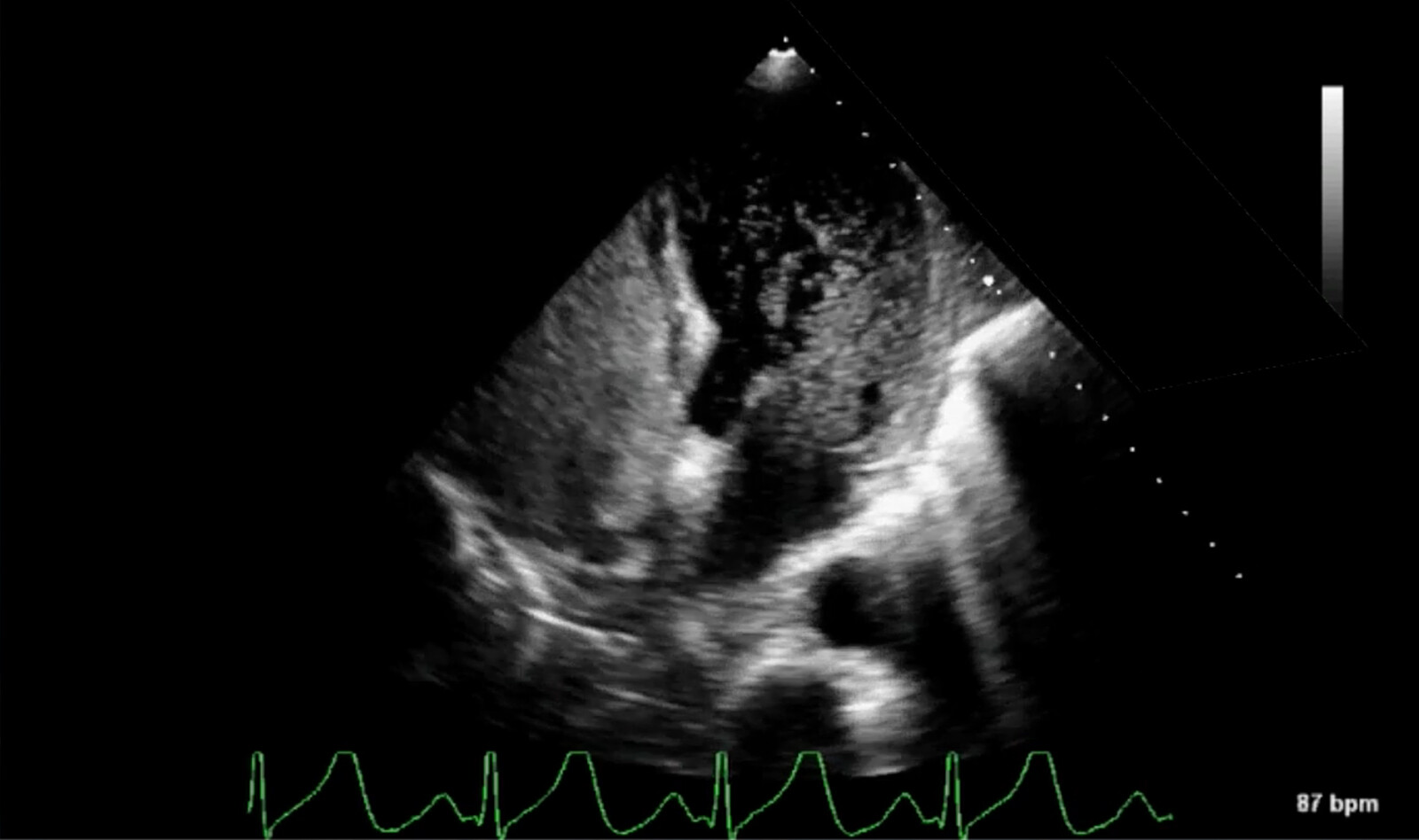 Image of hypotension cardiac ultrasound    Online PoCUS Training