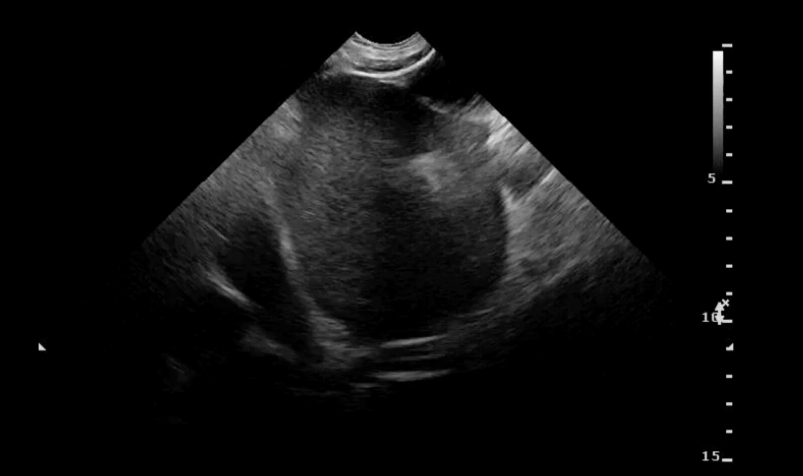 Image of hypotension cardiac ultrasound    Online PoCUS Training