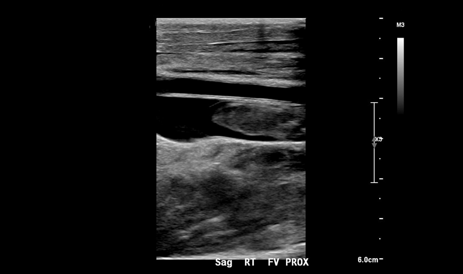 Image of point of care ultrasound point of care ultrasound hypotension    Online PoCUS Training