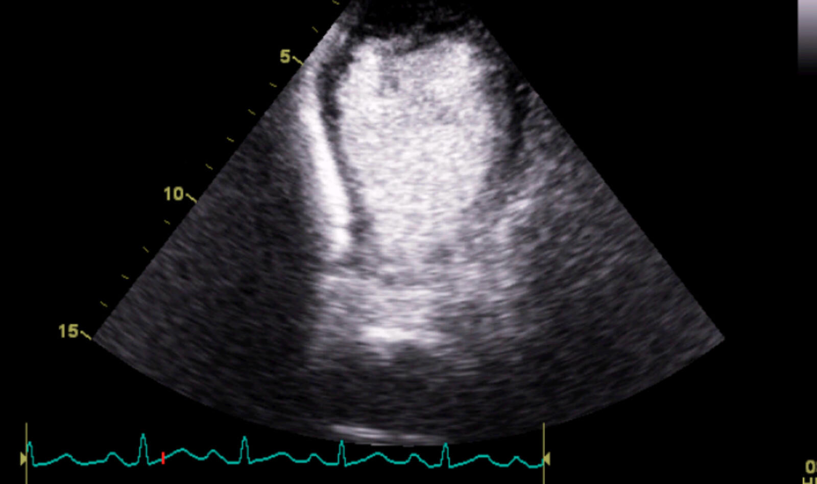 Image of PoCUS contrast echocardiography contrast echocardiography cardiac ultrasound cardiac PoCUS    Online PoCUS Training