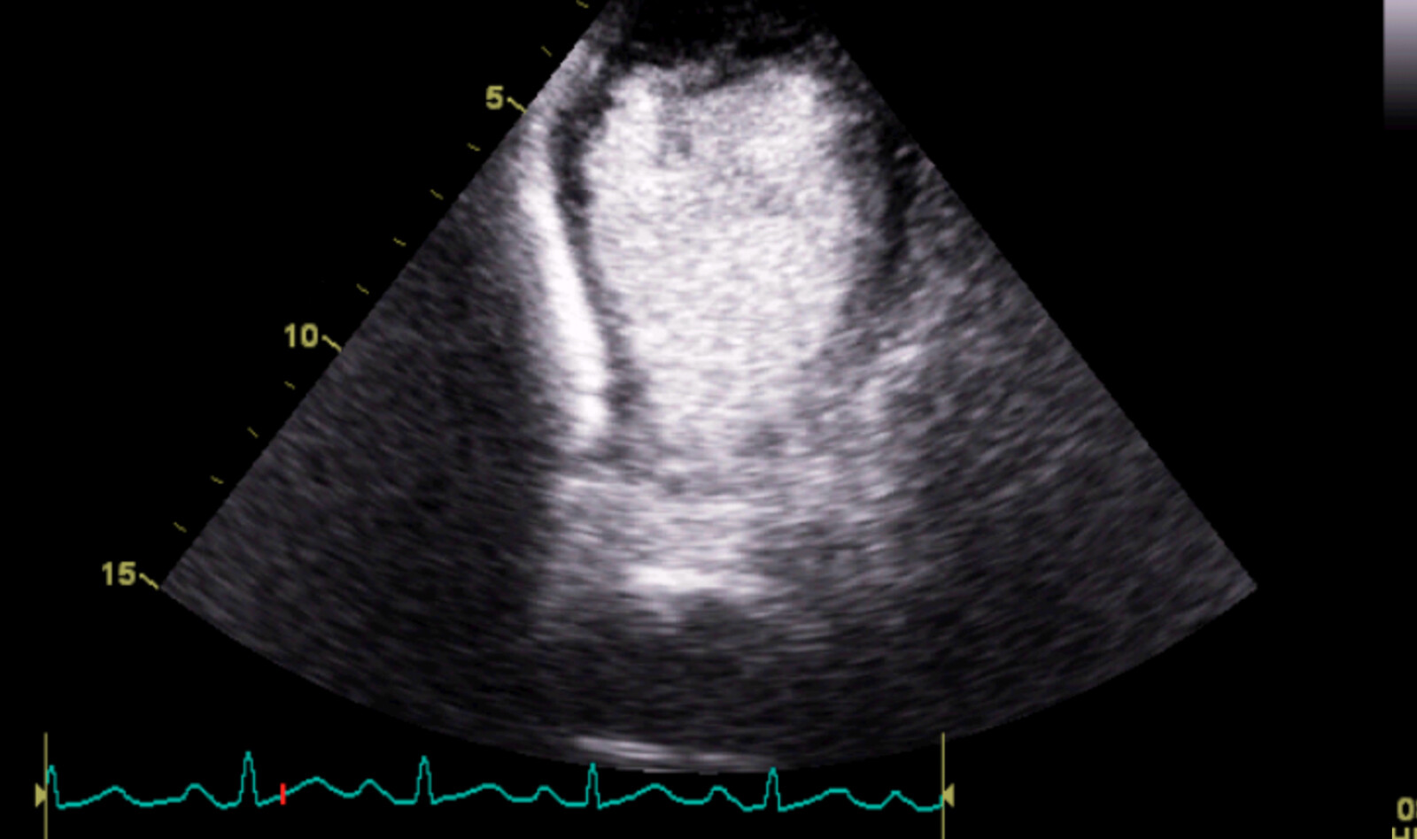 Image of point of care ultrasound emergency ultrasound emergency ultrasound echocardiogram critical care echocardiography    Online PoCUS Training