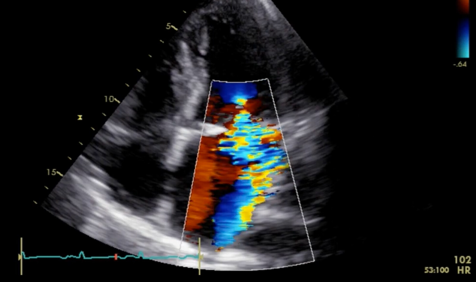 Image of heart ultrasound esophageal ultrasound echocardiography    Online PoCUS Training