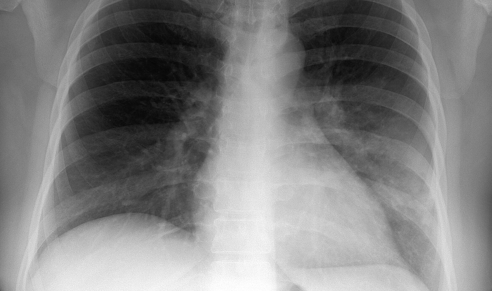 Image of Point of care system Pneumothorax Speckle tracking analysis lung ultrasound chest ultrasound    Online PoCUS Training