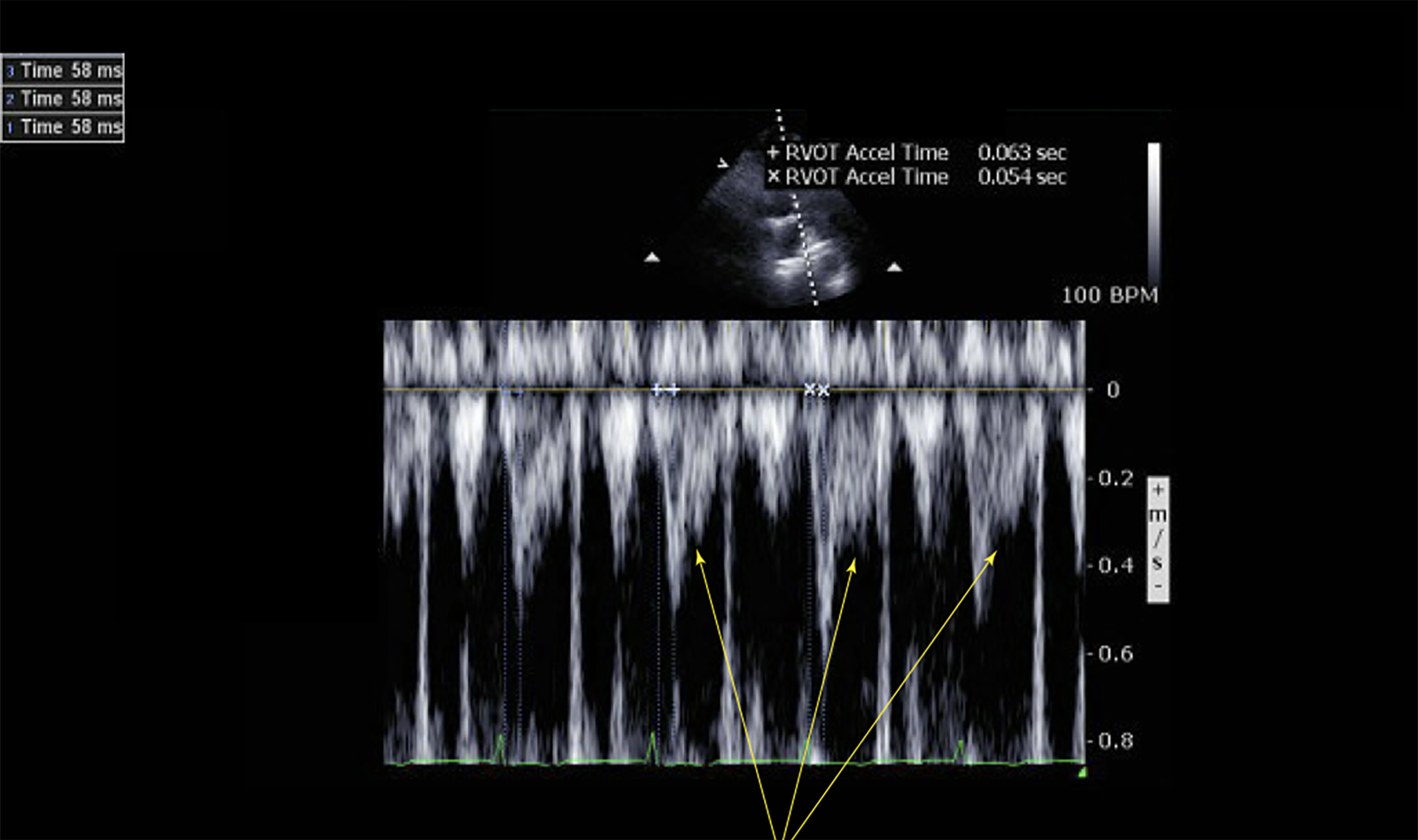 Image of pulmonary embolism echocardiography    Online PoCUS Training