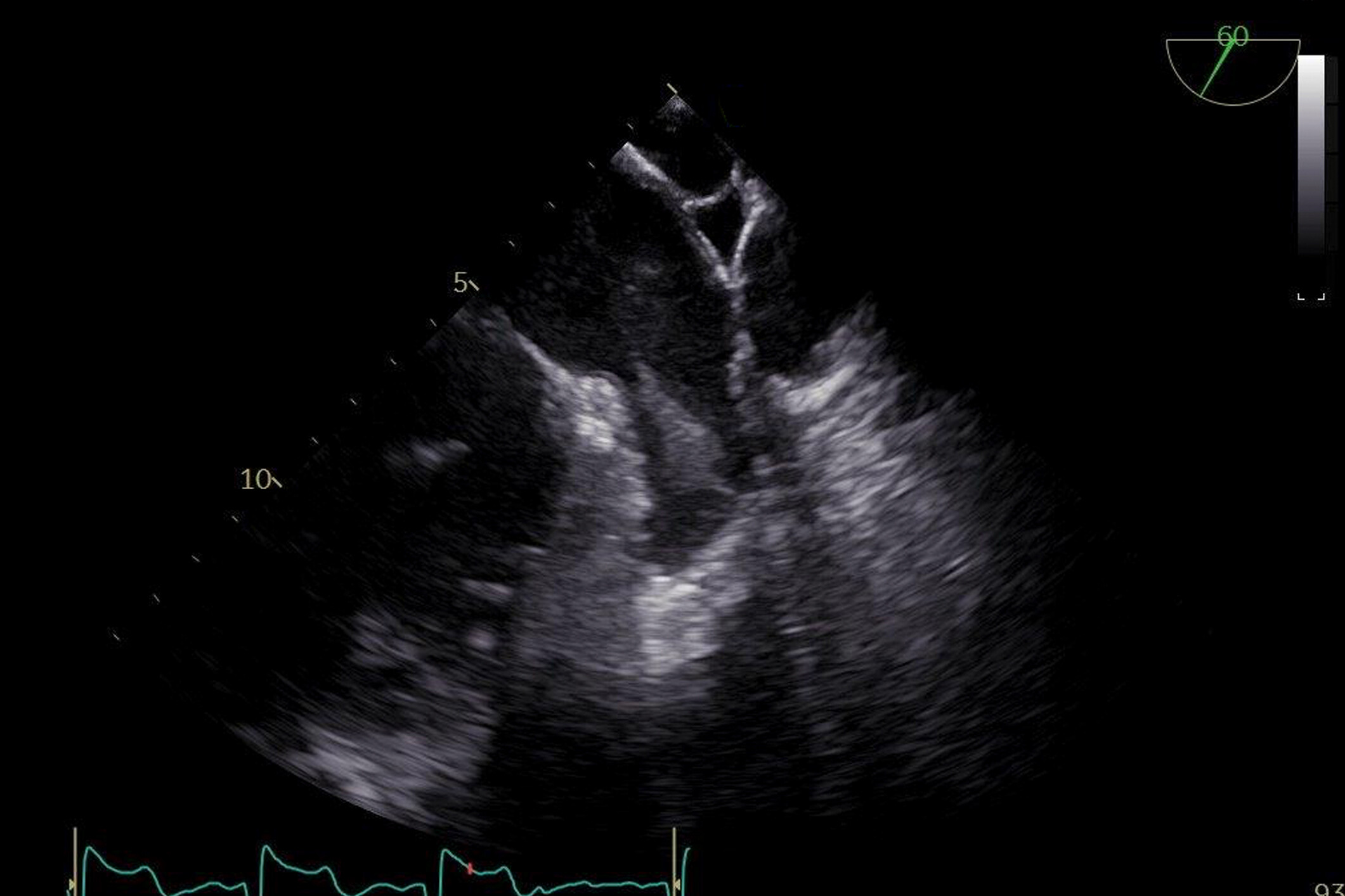 Image of ultrasound enhancing agents Transesophageal echocardiography TEE PoCUS ultrasound PoCUS Left atrial appendage thrombus contrast echocardiography    Online PoCUS Training
