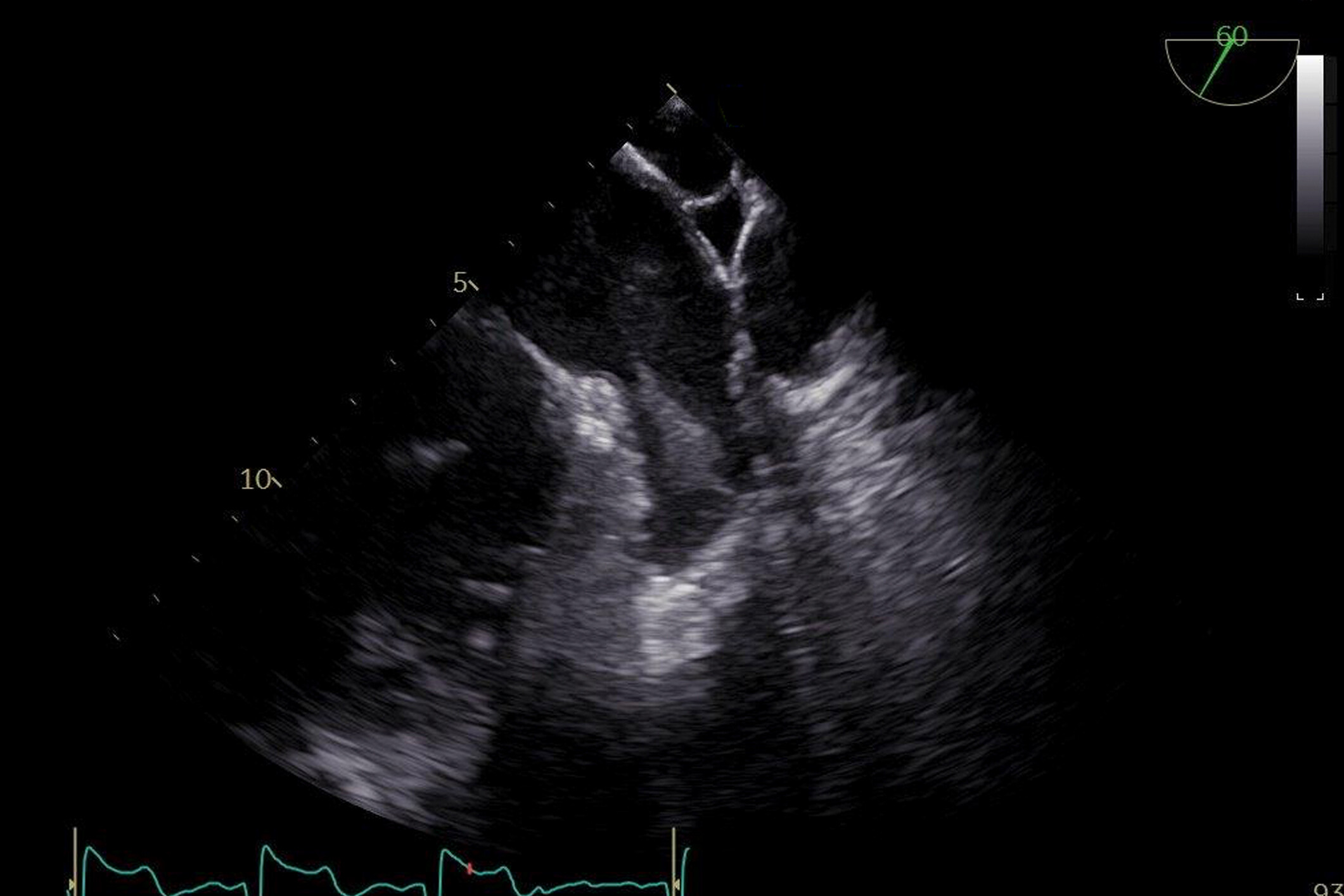 Image of ultrasound enhancing agents Transesophageal echocardiography TEE PoCUS ultrasound Left atrial appendage thrombus contrast echocardiography    Online PoCUS Training