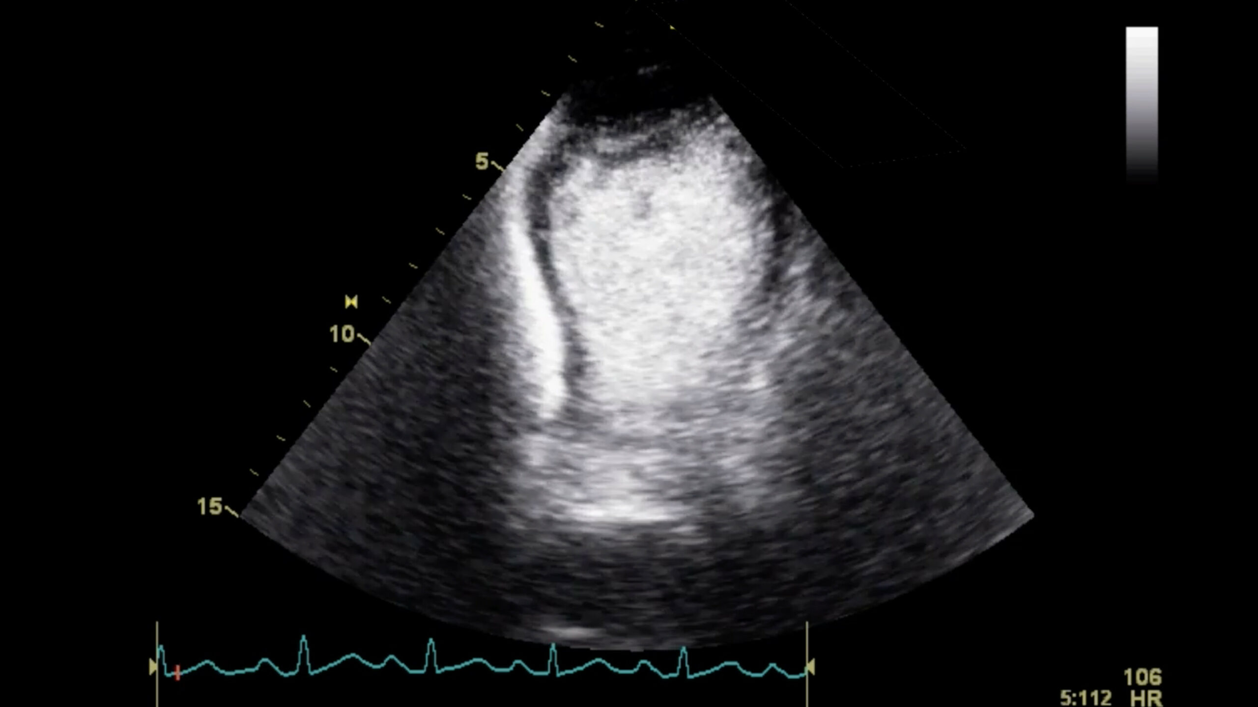 Image of Norepinephrine Myocardial Perfusion. contrast enhanced ultrasound Contrast echo Cariogenic shock    Online PoCUS Training
