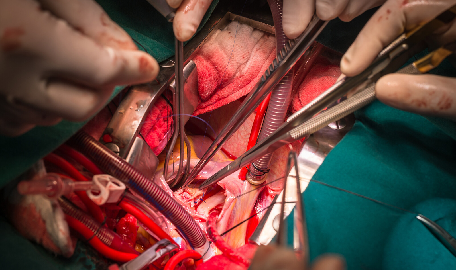 Image of contrast echocardiography cardiac PoCUS    Online PoCUS Training