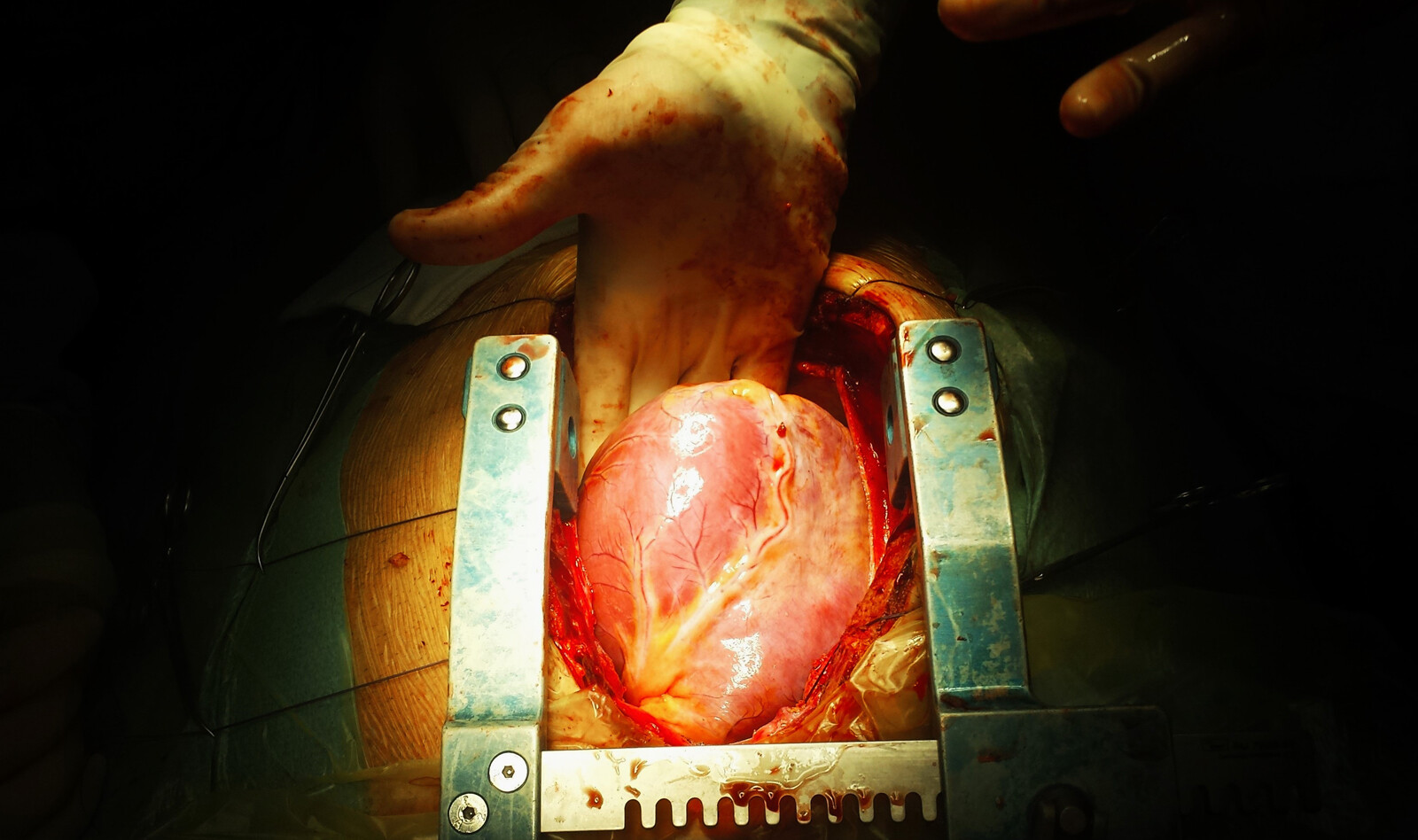 Image of pulmonary stenosis cardiac ultrasound Cardiac resynchronization therapy cardiac pacemaker    Online PoCUS Training