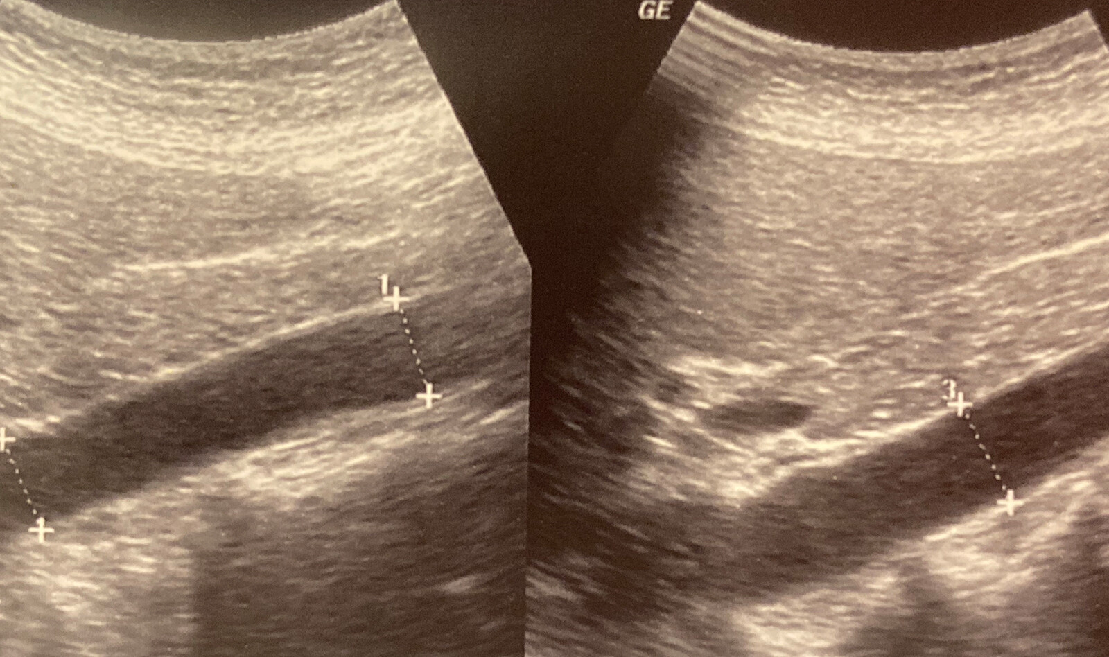 Image of ultrasound imaging Doppler Ultrasound. abdominal ultrasound Abdominal aortic aneurysm AAA    Online PoCUS Training