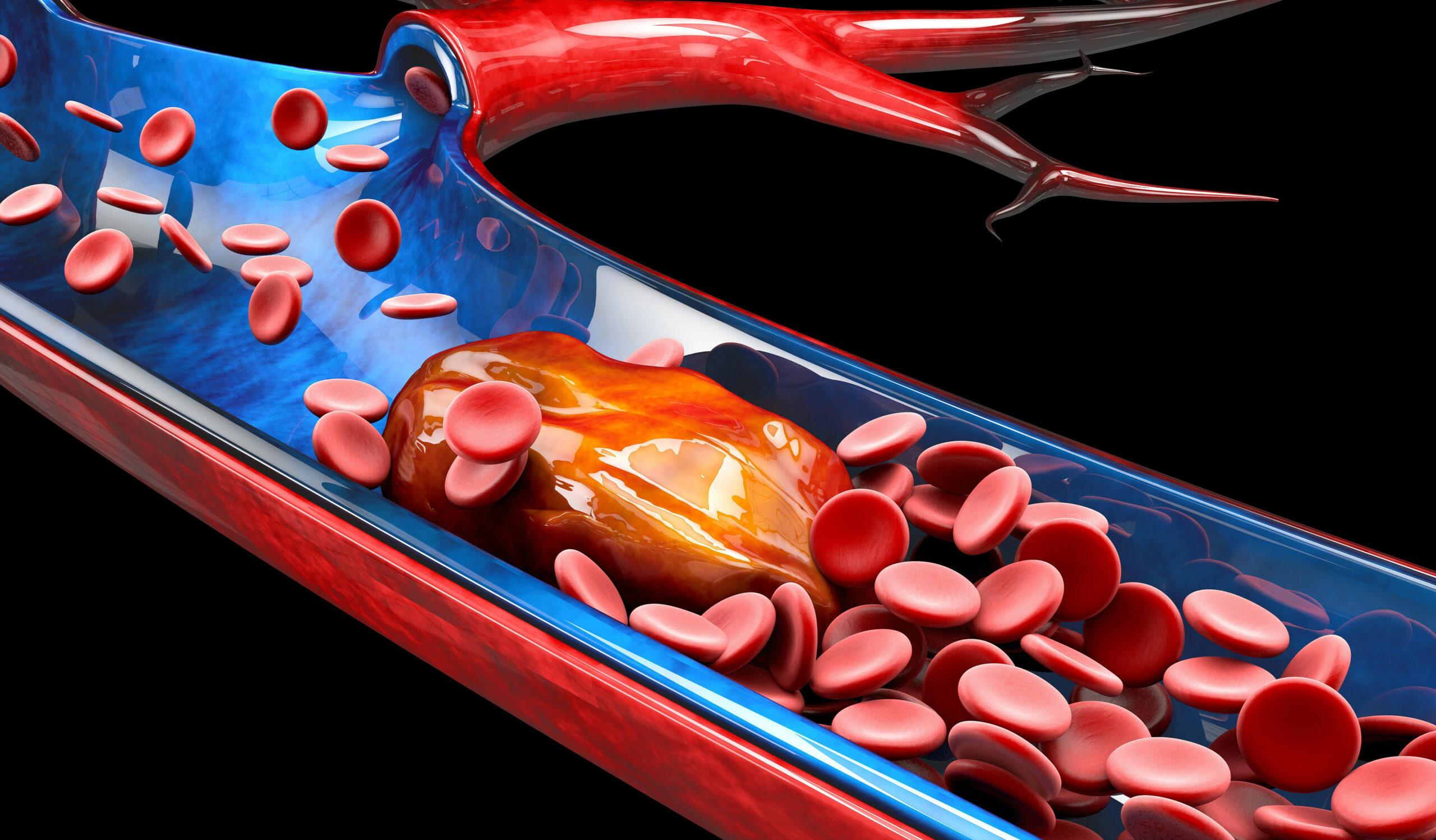 Image of thrombosis PoCUS arterial occlusion    Online PoCUS Training