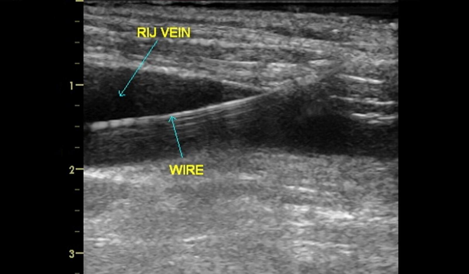 Image of ultrasound guided IJV cardiac surgery 3 dimensional ultrasound    Online PoCUS Training