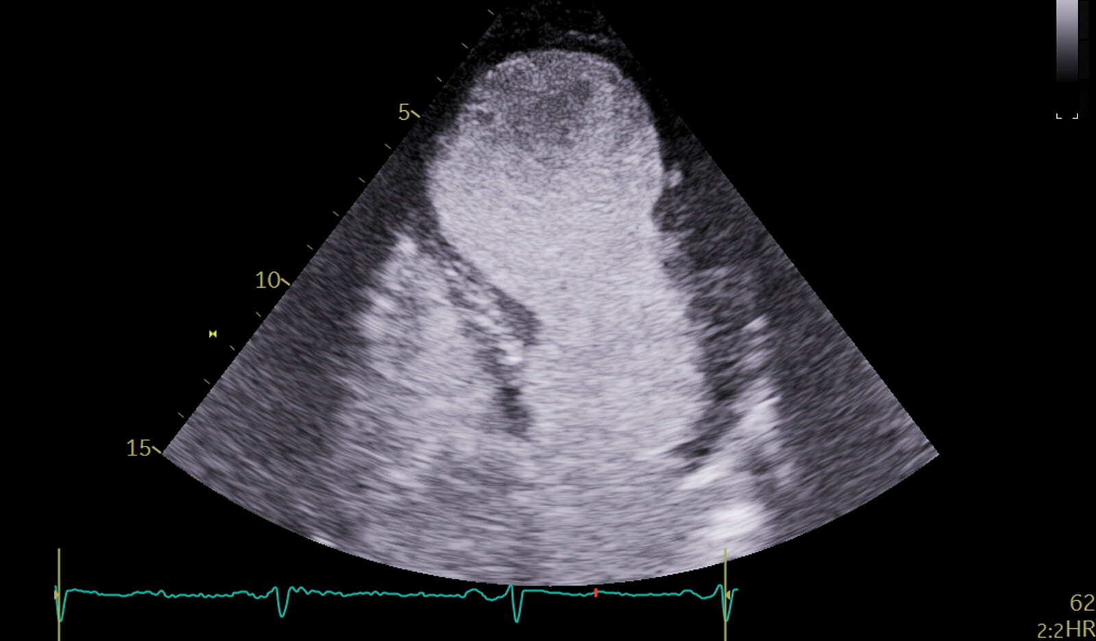 Image of measurements of cardiac size and function echocardiography critical care echocardiography    Online PoCUS Training