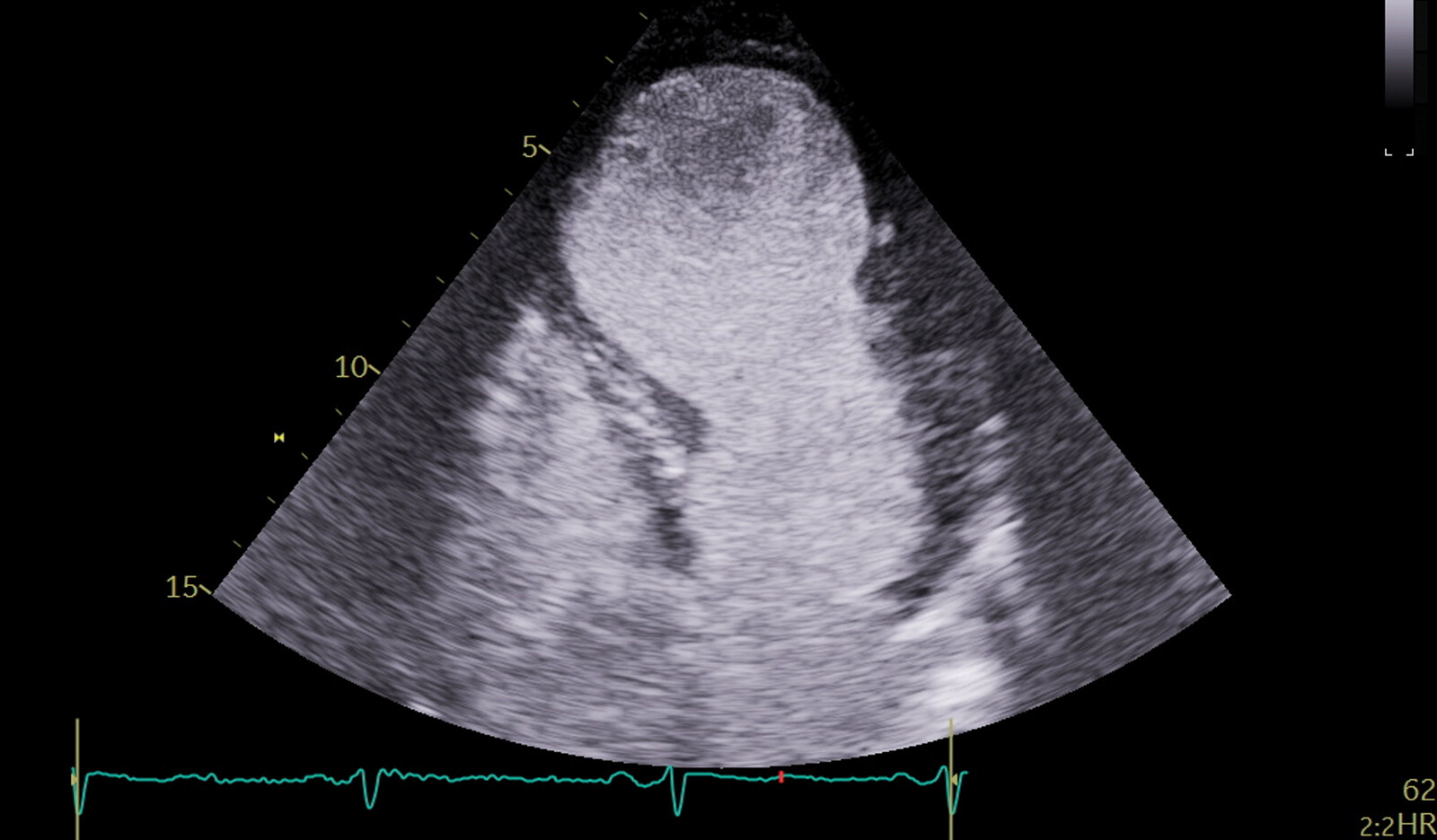 Image of ultrasound imaging transesophageal ultrasound Doppler Ultrasound. abdominal ultrasound Abdominal aortic aneurysm AAA    Online PoCUS Training