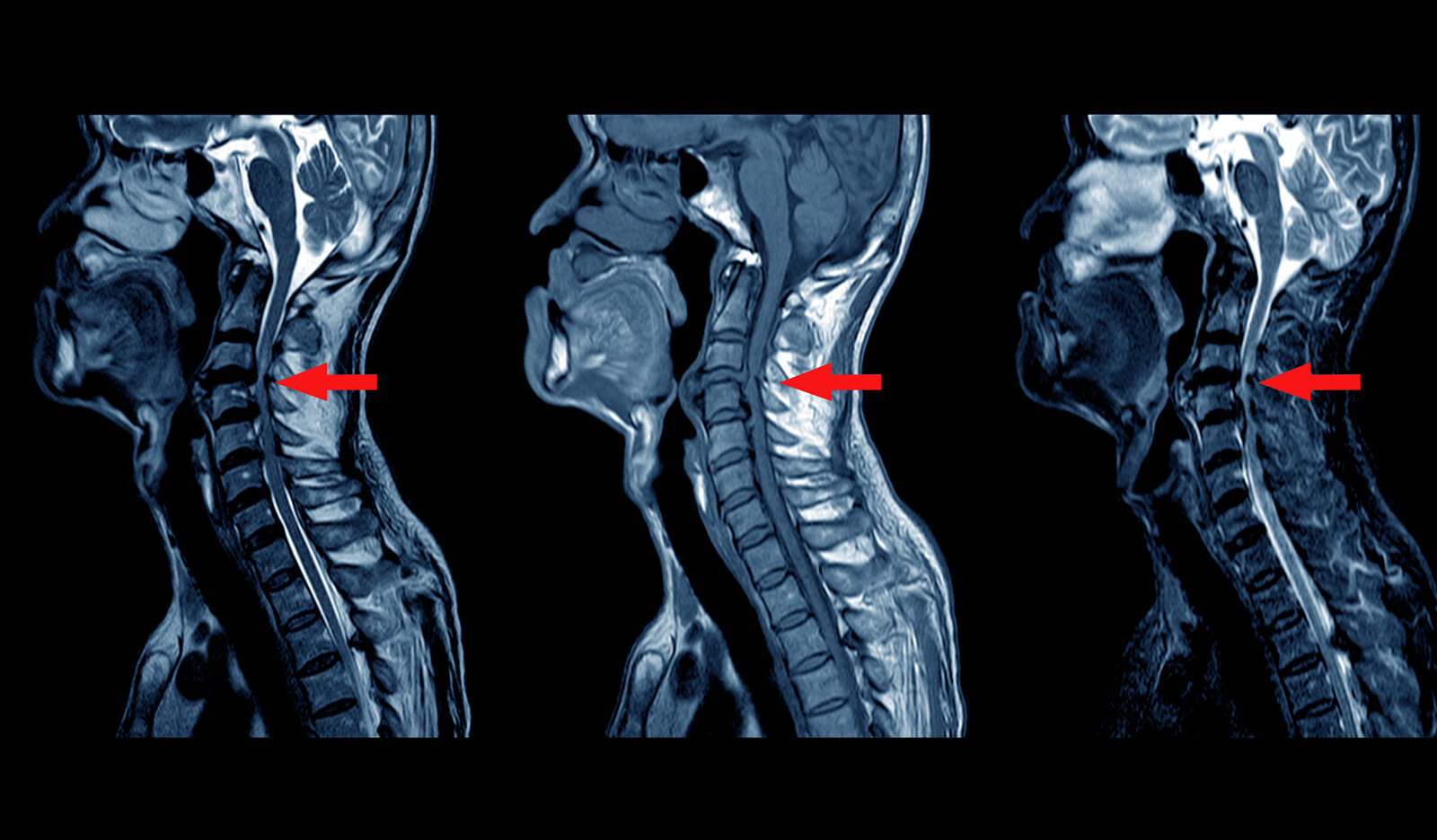 Image of PoCUS cervical spine injury C spine injury    Online PoCUS Training