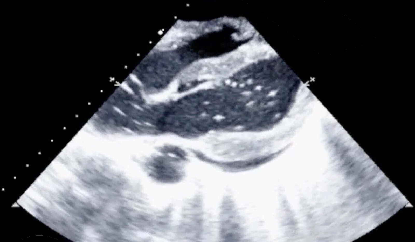Image of ultrasound enhancing agents measurements of cardiac size and function critical care echocardiography    Online PoCUS Training