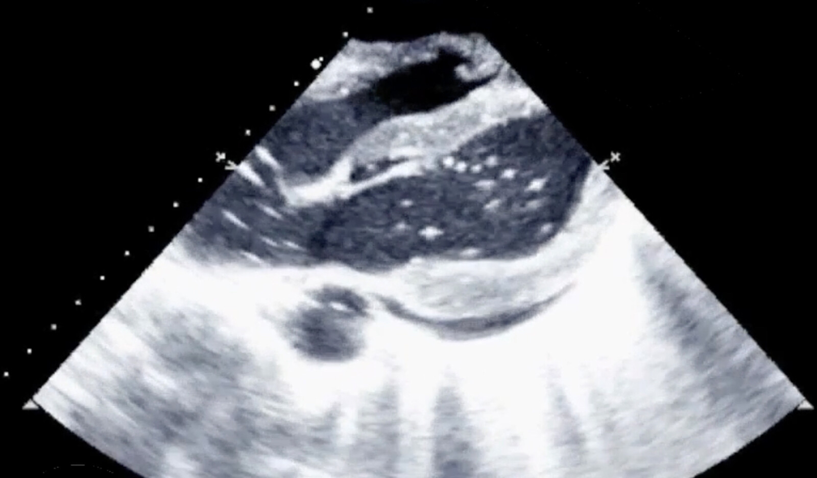 Image of skelatal muscle recruitable perfusion LVAD Left Ventricular Assist Device Implantation contrast ultrasound    Online PoCUS Training