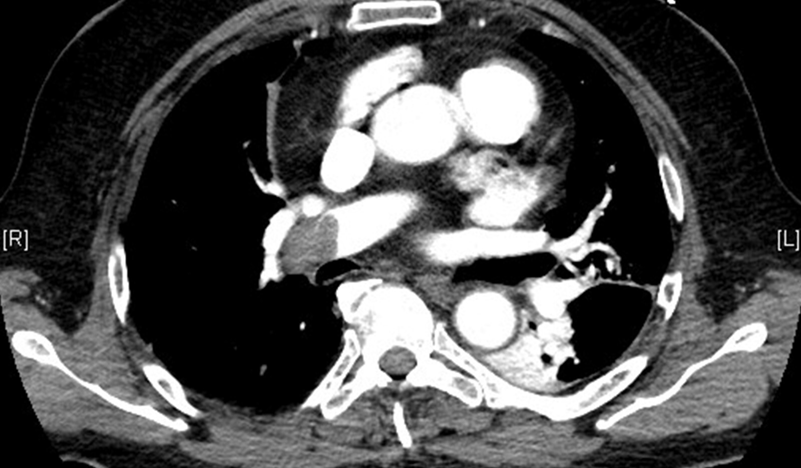 Image of primary lumbar hernia PoCUS Grynfeltt–Lesshaft Lumbar Hernia emergency ultrasound    Online PoCUS Training
