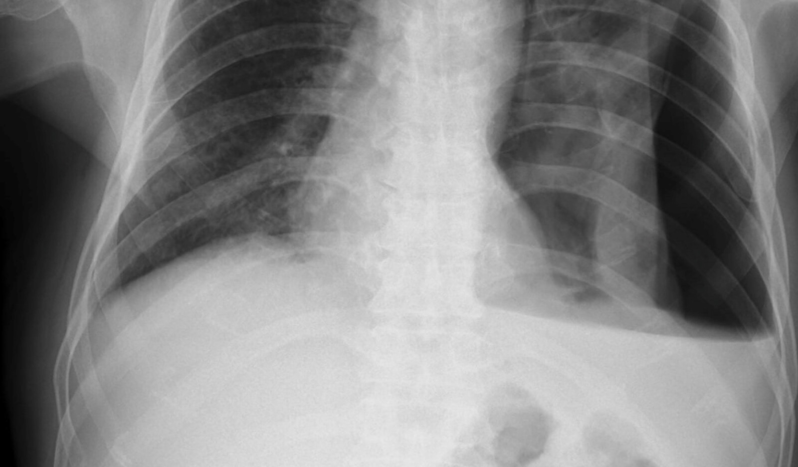 Image of Point of care system plural effusion Lung Ultrasonography chest ultrasound    Online PoCUS Training