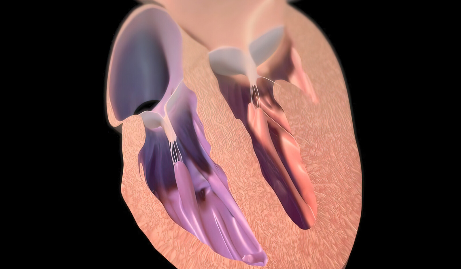 Image of Transthoracic Echocardiography systolic pulmonary artery pressure sPAP right heart catherization RHC PH cardiac ultrasound    Online PoCUS Training