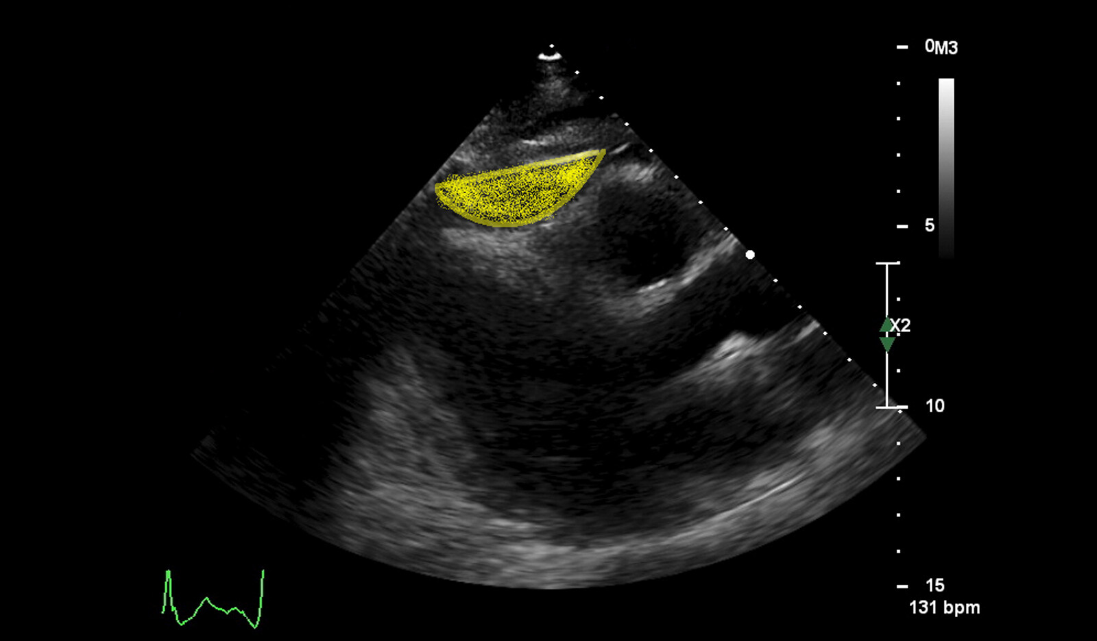 Image of two dimensional echo systolic function RV size RV function right ventricular measurements    Online PoCUS Training