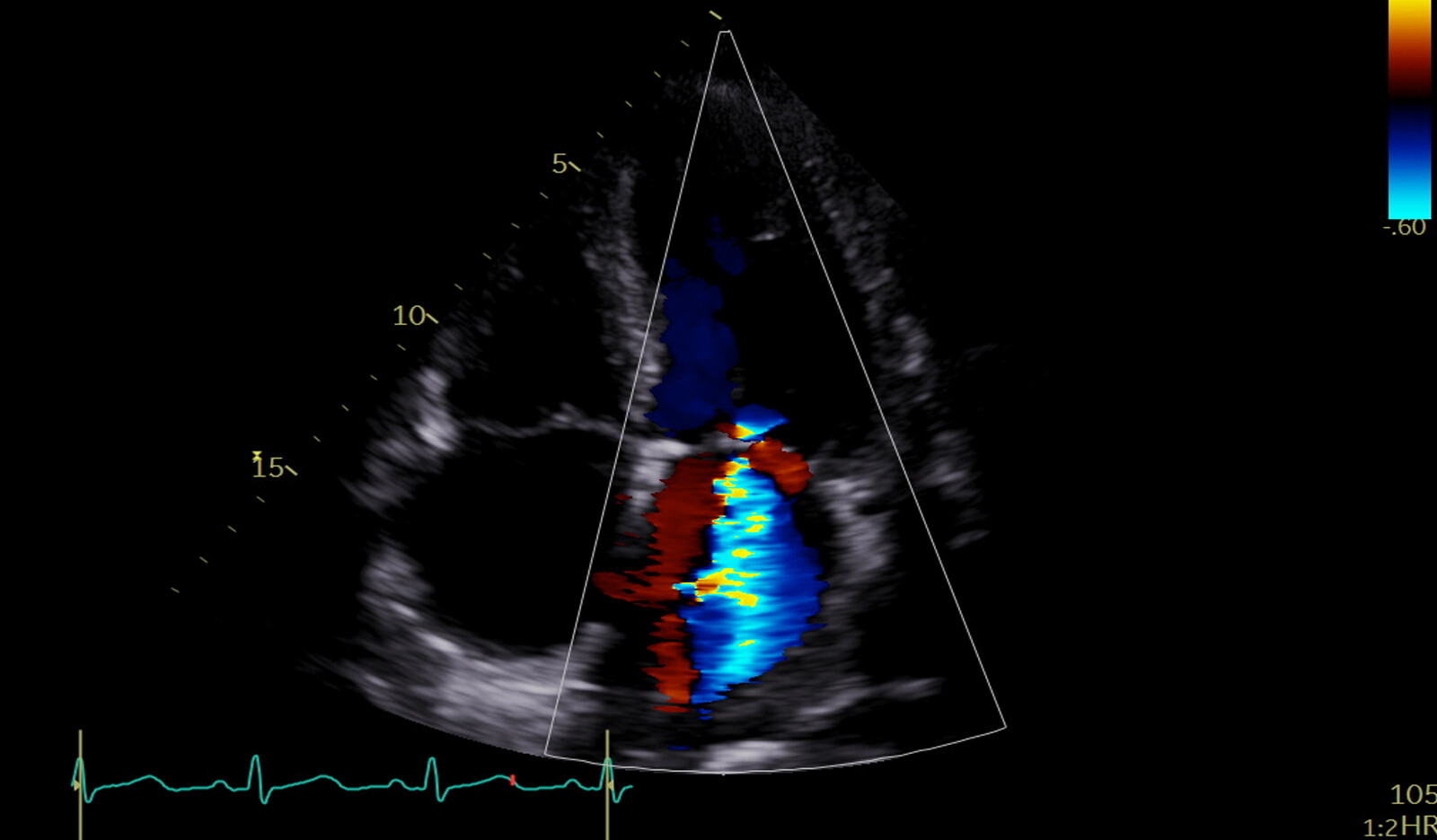 Image of two dimensional echo systolic function RV size RV function right ventricular measurements    Online PoCUS Training