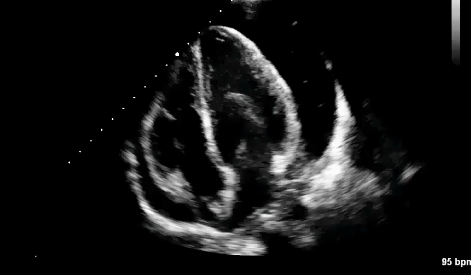 Image of moderate AS left ventricular global longitudal strain cardiac ultrasound AS aortic valve aortic stenosis    Online PoCUS Training