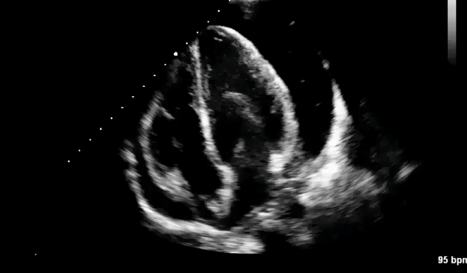 Image of SICM septic shock septic cardiomyopathy sepsis mitral annular plane systolic excursion MAPSE LVEF echocardiography echocardiography    Online PoCUS Training