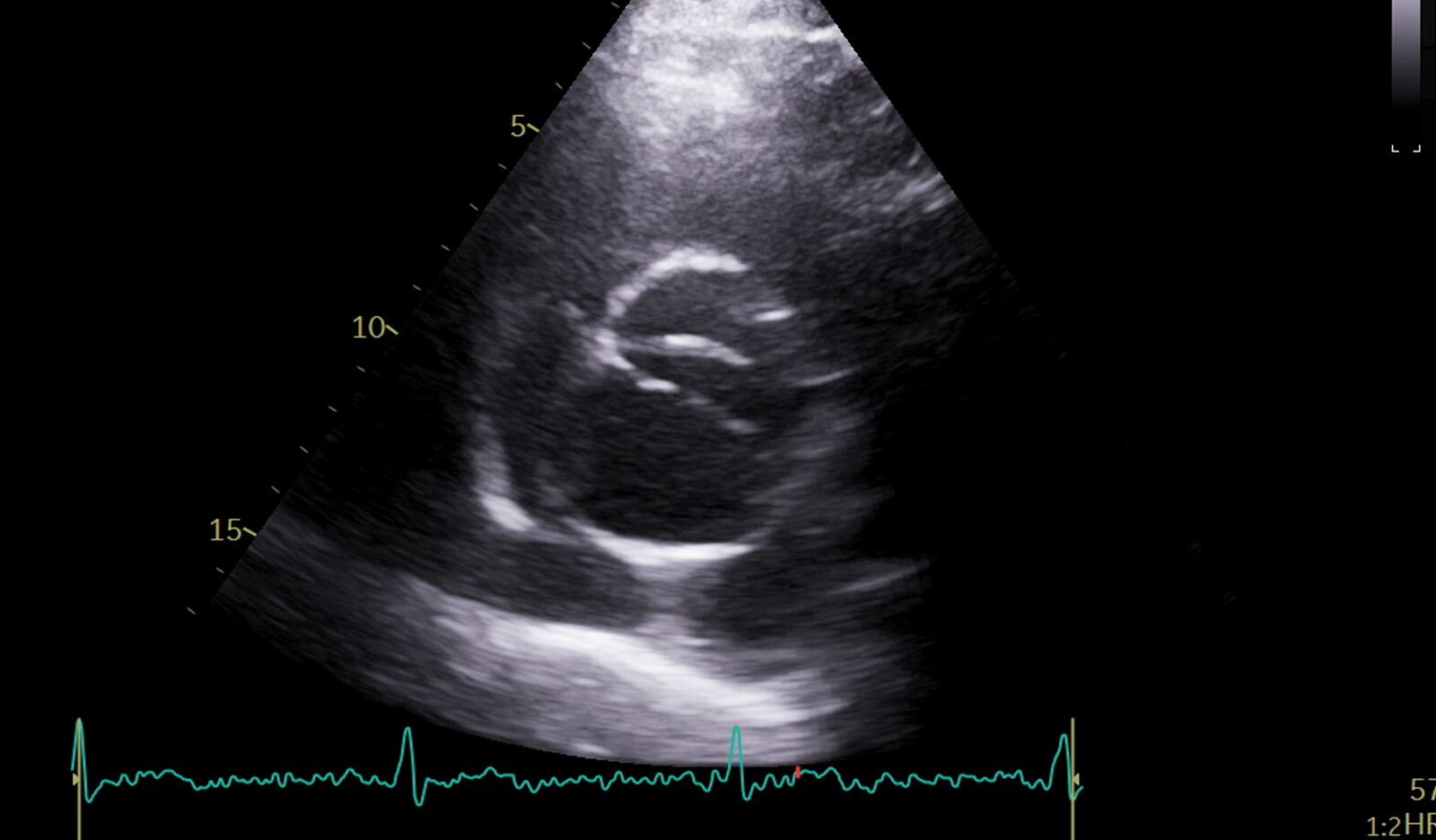 Image of moderate AS left ventricular global longitudal strain cardiac ultrasound AS aortic valve aortic stenosis    Online PoCUS Training