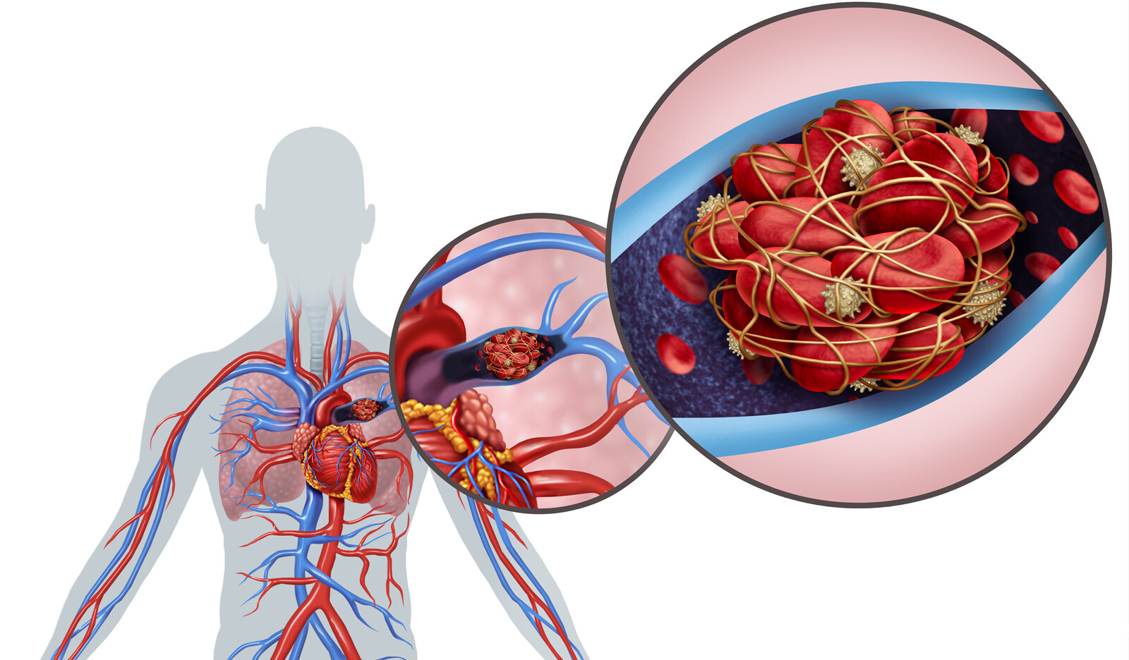 Image of pulmonary embolism Pericardial Tamponade PE McConnels sign diagnostic ultrasonography computed tomography pulmonary angiography    Online PoCUS Training