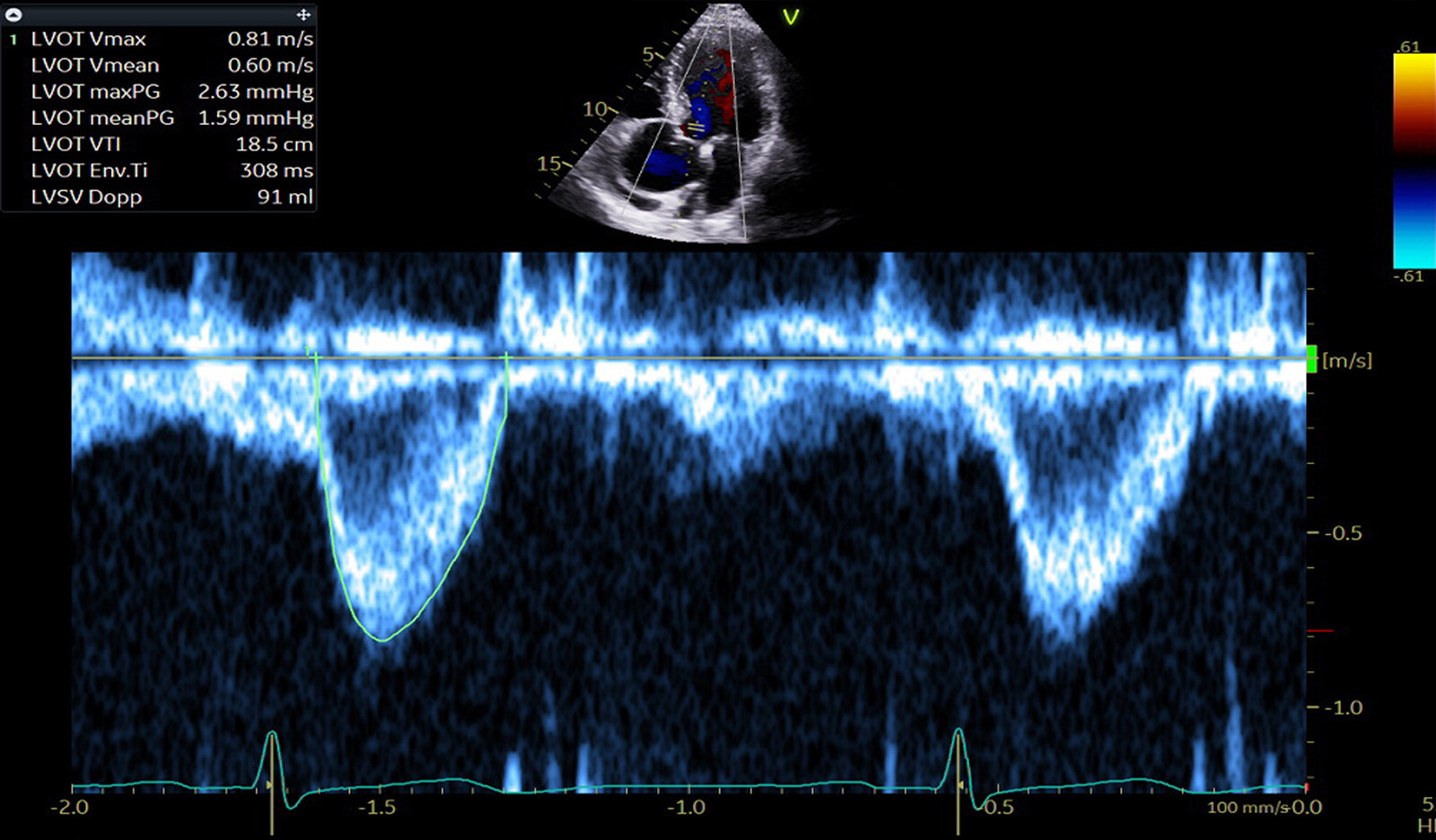 Image of Transthoracic Echocardiography systolic pulmonary artery pressure sPAP right heart catherization RHC PH cardiac ultrasound    Online PoCUS Training
