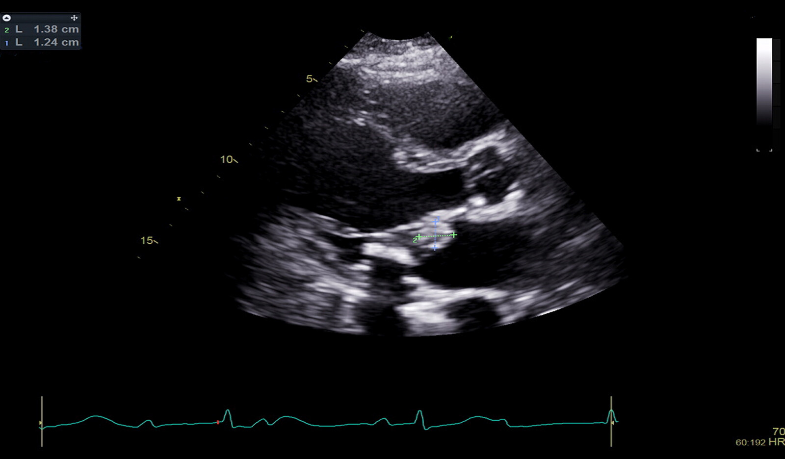 Image of ventricular filbrillation TVP TAD OHCA MVP MAD echocardiography cardiac imaging cardiac imaging cardiac imaging cardiac arrest    Online PoCUS Training