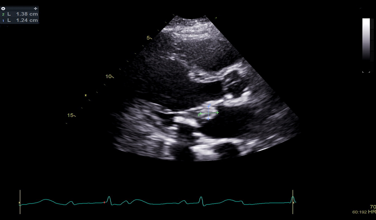 Image of pulmonary stenosis cardiac ultrasound Cardiac resynchronization therapy cardiac pacemaker    Online PoCUS Training