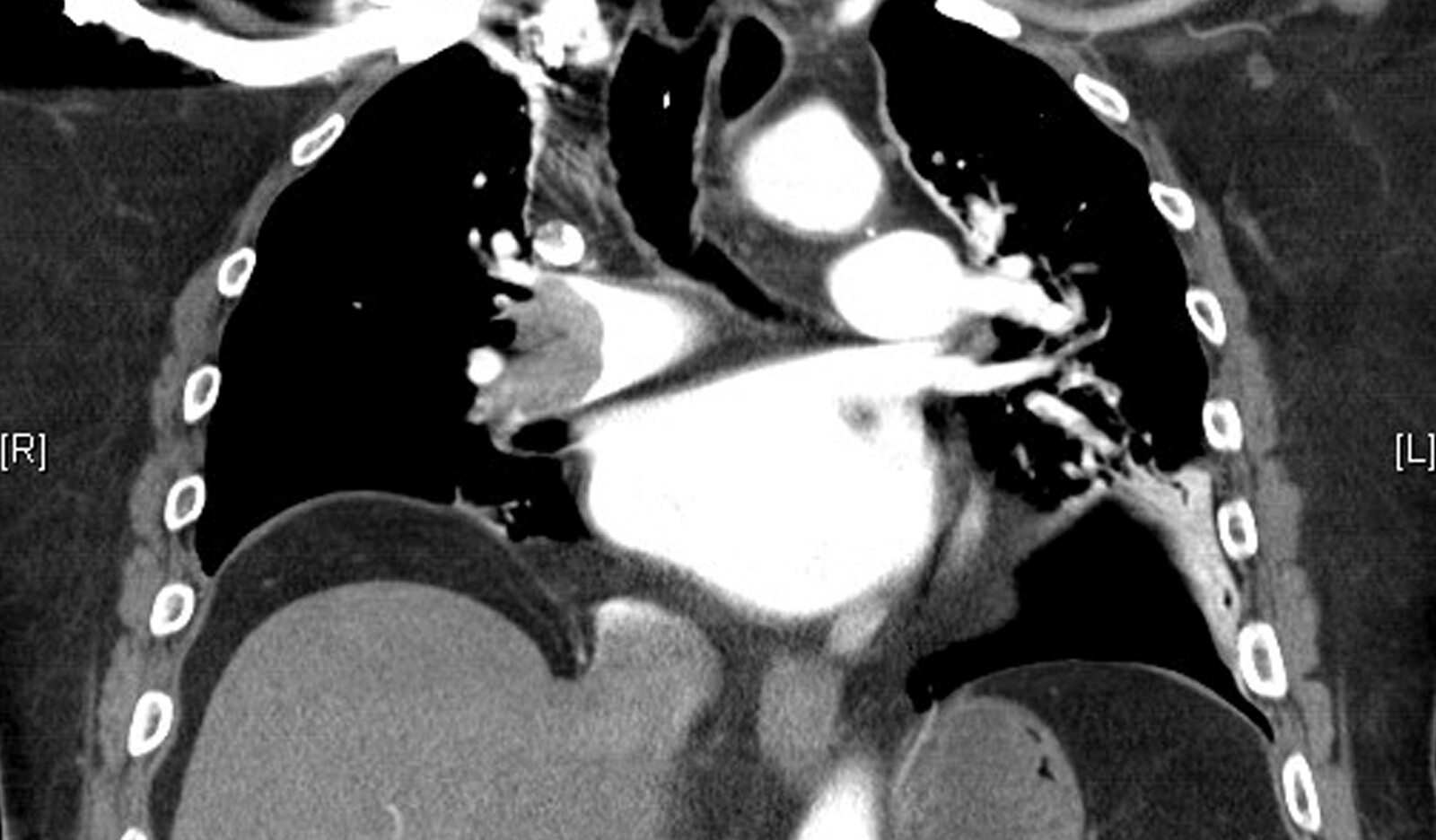 Image of pulmonary embolism point of care ultrasound PoCUS pleuritic chest pain. PE lung ultrasound    Online PoCUS Training