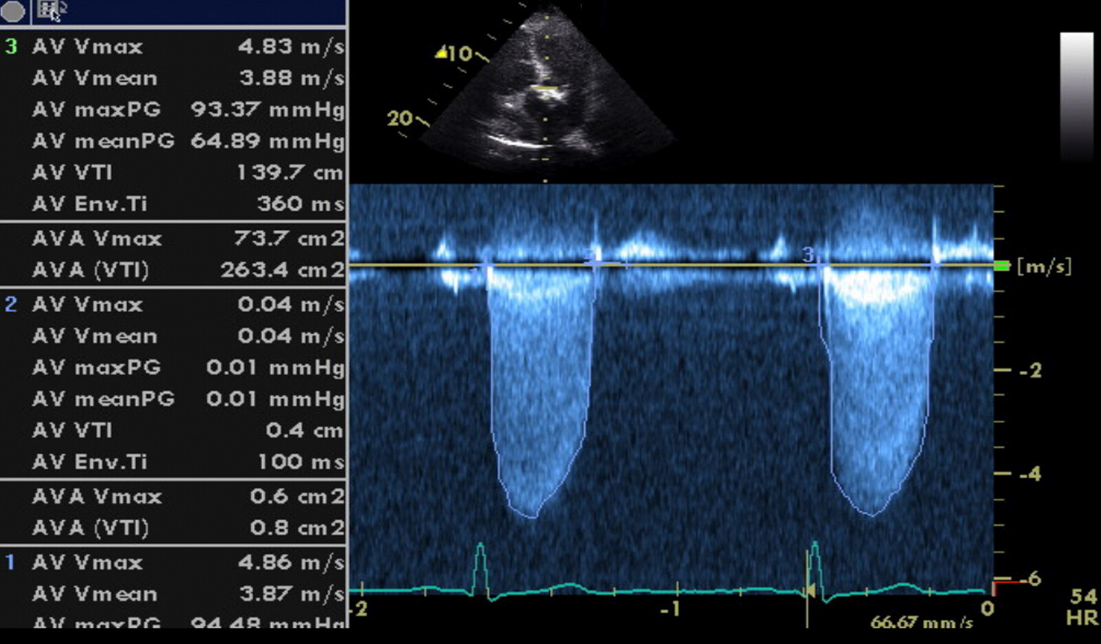 Image of TTE doppler cardiac imaging AS aortic valve stenosis aortic stenosis    Online PoCUS Training