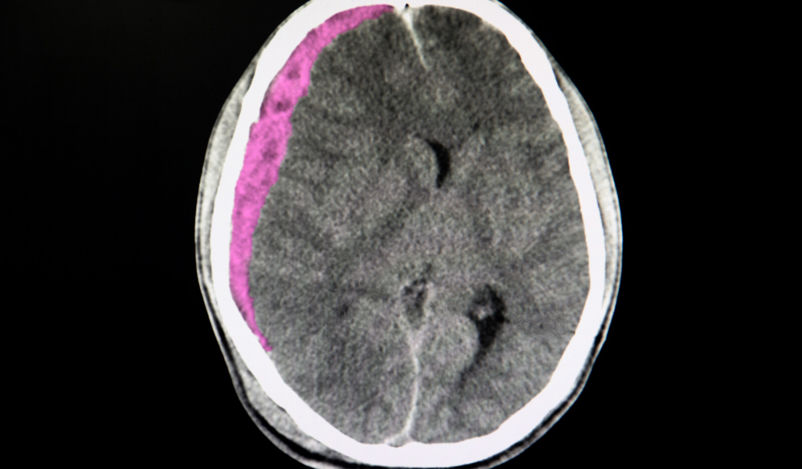 Image of Transcranial ultrasound point of care ultrasound PoCUS Intracranial pathology Intracranial hemorrhage    Online PoCUS Training